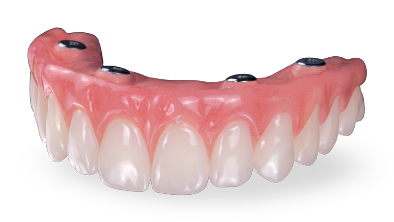 Model of a full-arch fixed implant bridge supported by four dental implants